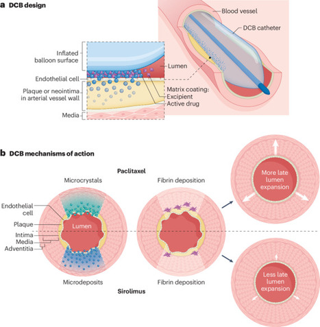 Drug-coated balloon angioplasty for coronary and peripheral artery disease: latest evidence and clinical indications&nbsp; | Interventional Cardiology | Scoop.it