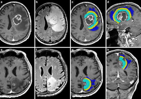 A novel approach for brain tumor detection and ...