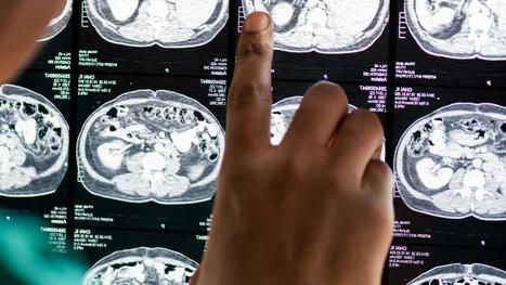 Un estudio pionero español revela la estrategia a seguir para prevenir el alzhéimer | Alzheimer y más (Boletín nº 73) | Scoop.it