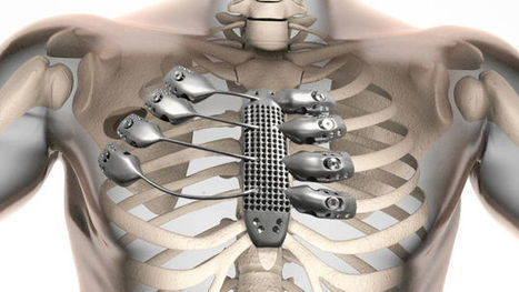 The World's First 3D-Printed Titanium Rib Cage Is a Medical Marvel | #3DPrinting | 21st Century Innovative Technologies and Developments as also discoveries, curiosity ( insolite)... | Scoop.it