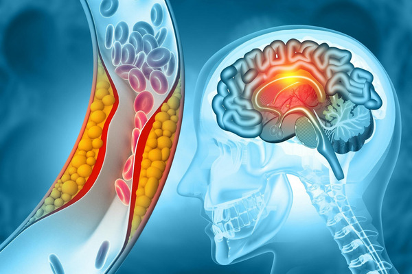 Blocking GAPDH aggregation protects brain cells and opens new path for stroke therapy | Neurovascular Intervention | Scoop.it