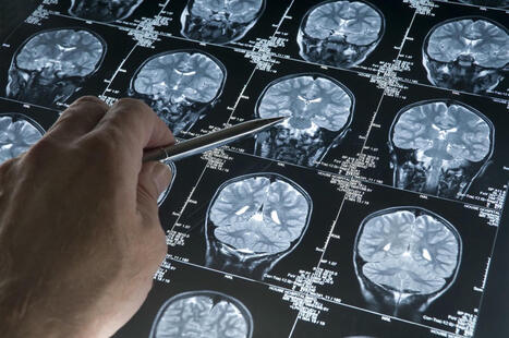 La combinación de dos pruebas PET permite prever mejor qué personas desarrollarán Alzheimer a corto plazo | Alzheimer y más (Boletín nº 66) | Scoop.it