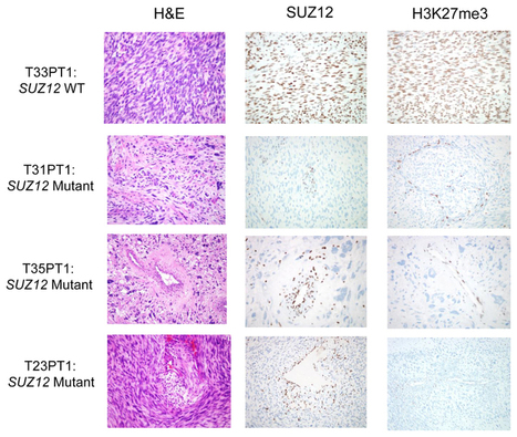 Somatic mutations of SUZ12 in malignant peripheral nerve sheath tumors - Nature Genetics | Genetics - GEG Tech top picks | Scoop.it