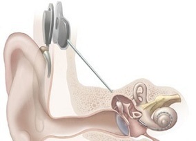 Perte d'audition : vers des implants cochléaires en Wi-Fi | Revue de presse Implant Cochléaire | Scoop.it