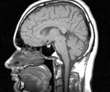 Good news: Migraines hurt your head but not your brain | Kinsanity | Scoop.it