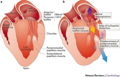Functional Mitral Valve Regurgitation: Mitral Valve Repair or Replacement? | Transcatheter Treatment of Mitral Regurgitation | Scoop.it