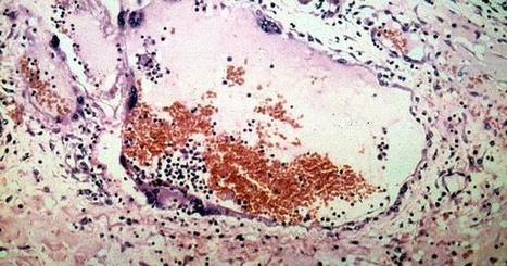 Nipah virus in Kerala: 10 dead, 22 people quarantined | Virology News | Scoop.it