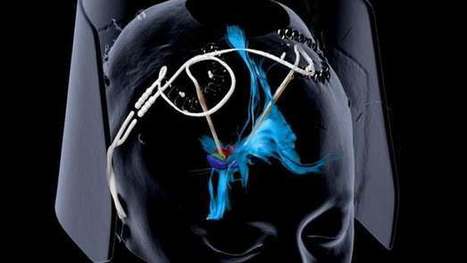 Deep brain stimulation provides fast-acting and long-lasting relief of severe depression | Soup for thought | Scoop.it