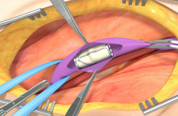 FDA denies PMA submission for enVVeno Medical's VenoValve | Interventional Cardiology | Scoop.it