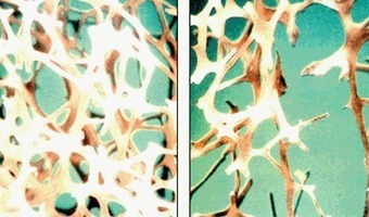 Wanneer moet u zich laten testen op osteoporose? | Voeding en vrouw in de overgang | Scoop.it