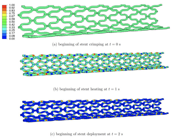 Nitinol Stent Placement in a Stenosed Artery: A Highly Nonlinear Application Scenario for Two Novel Finite-Element Models | Neurovascular Intervention | Scoop.it