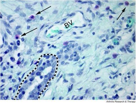 Mast cells in inflammatory arthritis | Rheumatology-Rhumatologie | Scoop.it