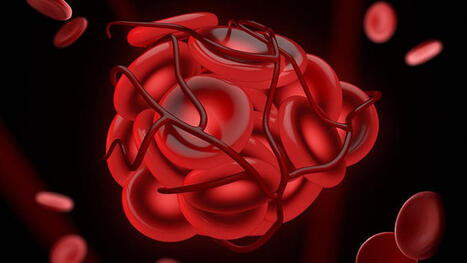 Stop Dual Antithrombotic Therapy in AF Patients With Stents | Interventional Cardiology | Scoop.it
