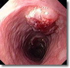 UniversitätsKlinikum Heidelberg: Ösophaguskarzinom | Speiseröhren Krebs | #Cancer | 21st Century Innovative Technologies and Developments as also discoveries, curiosity ( insolite)... | Scoop.it