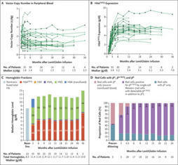Biologic and Clinical Efficacy of LentiGlobin for Sickle Cell Disease | NEJM | Hematology | Scoop.it