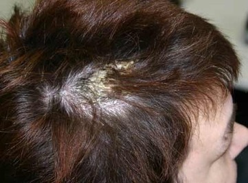Schilfering op het behaarde hoofd | huidinfo.nl | heldere informatie van de dermatoloog | Informatie over haar | Scoop.it