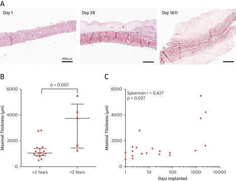 Transcatheter Aortic Heart Valves: Histological Analysis Providing Insight to Leaflet Thickening and Structural Valve Degeneration | Transcatheter Treatment of Mitral Regurgitation | Scoop.it