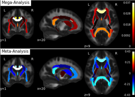 D&eacute;couverte d&rsquo;anomalies &eacute;tendues de la microstructure de la mati&egrave;re blanche dans le trouble bipolaire | Life Sciences Universit&eacute; Paris-Saclay | Scoop.it