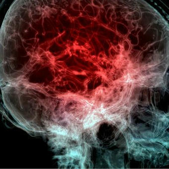 Des quantités alarmantes de microplastiques retrouvées dans le cerveau humain | Alimentation Santé Environnement | Scoop.it