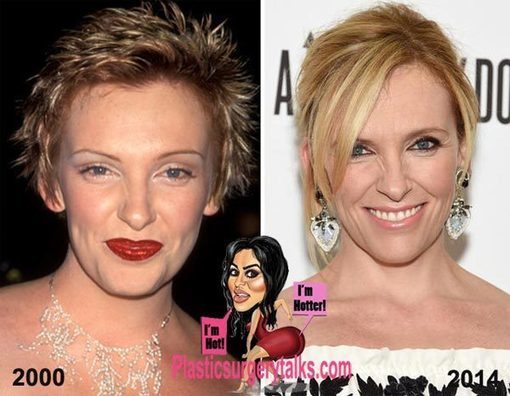 Toni Collette Plastic Surgery – Fact or F...