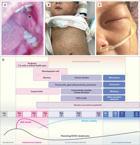 𝗔 𝗡𝗲𝘄 𝗥𝗲𝘃𝗶𝗲𝘄 𝗔𝗿𝘁𝗶𝗰𝗹𝗲 𝗼𝗻 𝗠𝗲𝗮𝘀𝗹𝗲𝘀 | NEJM Group | Hésitations Vaccinales: Observatoire HESIVAXs | Scoop.it