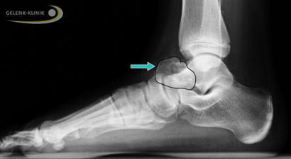 Kartilaginäre Exostose (Osteochondrom) am Talus (Sprunggelenk) | www.gelenk-doktor.de | #Health #Santé #Gesundheit | 21st Century Innovative Technologies and Developments as also discoveries, curiosity ( insolite)... | Scoop.it