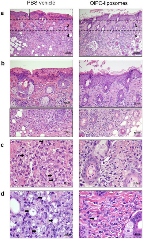 Drug Delivery by Tattooing to Treat Cutaneous Leishmaniasis | Intra-Dermal drug delivery: Opportunities and Challenges? | Scoop.it