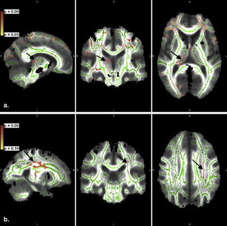 Putative brain iron content indicates changes related to Parkinson’s | #ALS AWARENESS #LouGehrigsDisease #PARKINSONS | Scoop.it