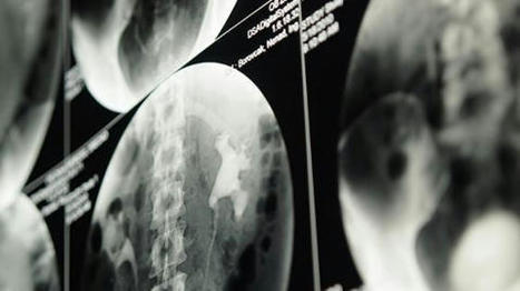 Hemodialysis Versus Peritoneal Dialysis Drug Expenditures | Peritoneal dialysis | Scoop.it