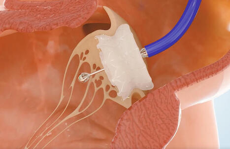 Capstan Medical completes robotic catheter mitral valve replacement | Transcatheter Treatment of Mitral Regurgitation | Scoop.it