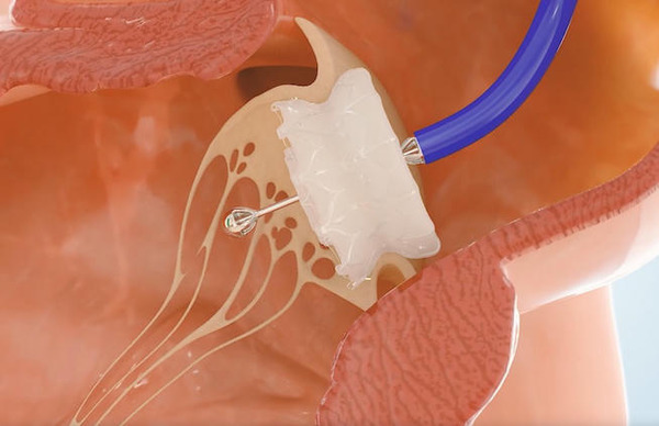 Capstan Medical completes robotic catheter mitral valve replacement | Transcatheter Treatment of Mitral Regurgitation | Scoop.it