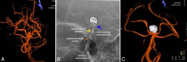 Early postmarket results with PulseRider for treatment of wide-necked intracranial aneurysms | Neurovascular Intervention | Scoop.it