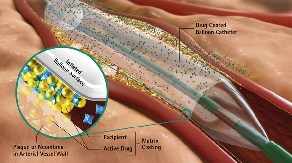 Drug-coated balloon angioplasty in coronary artery disease: state of the art review | npj Cardiovascular Health | Interventional Cardiology | Scoop.it