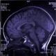 Alzheimer's Disease Symptoms Reversed in Mice (Scientific American) | Longevity science | Scoop.it