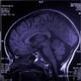 Alzheimer's Disease Symptoms Reversed in Mice (Scientific American) | Longevity science | Scoop.it