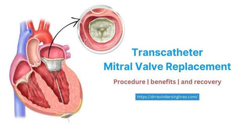 Transcatheter Mitral Valve Replacement (TMVR)