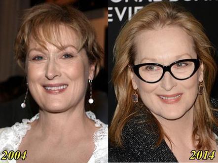 free meryl streep plastic surgery