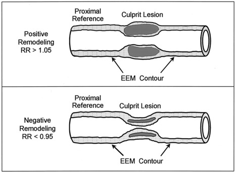 Arterial Remodeling After Coronary Angioplasty | Interventional Cardiology | Scoop.it