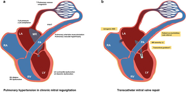 Pulmonary Hypertension in Patients Eligible for Transcatheter Mitral Valve Repair: Prognostic Impact and Clinical Implications | Transcatheter Treatment of Mitral Regurgitation | Scoop.it