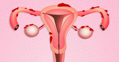 Terapi kan lindra smärta hos patienter med endometrios | Åboland | 1Uutiset - Lukemisen tähden | Scoop.it