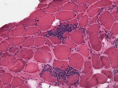 Risk Prediction Modeling in MDA5 Dermatomyositis | RheumNow | AUTOIMMUNITY | Scoop.it