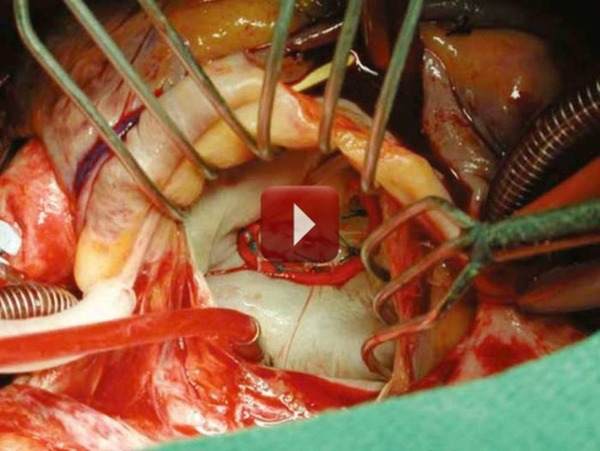 Full Complex Reoperative Mitral Valve Surgery | Transcatheter Treatment of Mitral Regurgitation | Scoop.it