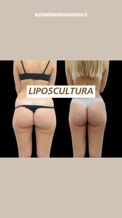 Liposcultura Brescia e Parma - Ridefinisci il tuo corpo | Dr. Pietro Martinelli | Medicina Estetica News | Scoop.it