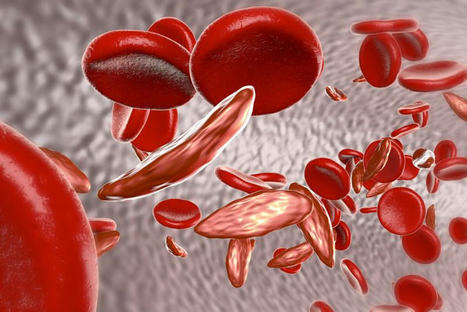 News: Disease Roundup: Sickle Cell Disease and CRISPR | Vectorology - GEG Tech top picks | Scoop.it