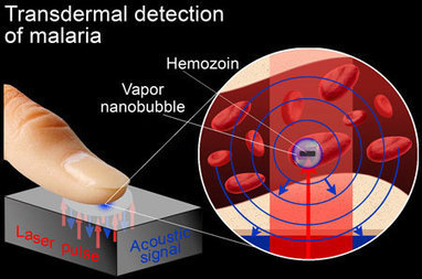 Vapor nanobubbles rapidly detect malaria through the skin | 21st Century Innovative Technologies and Developments as also discoveries, curiosity ( insolite)... | Scoop.it