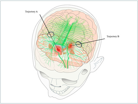 Minimally Invasive Surgery for Spontaneous Intracerebral Hemorrhage | Neurovascular Intervention | Scoop.it