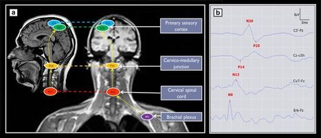 Nouvel outil de pronostic pr&eacute;coce des personnes sous fortes doses de s&eacute;datifs | Life Sciences Universit&eacute; Paris-Saclay | Scoop.it