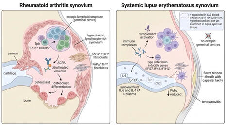 #sle #lupus #sle #immunology #rheumatology #precisionmedicine | Chris Wincup | Rheumatology-Rhumatologie | Scoop.it