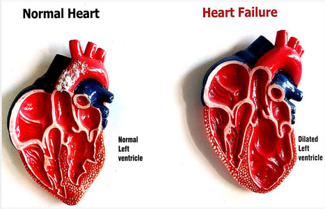 Advances in management of heart failure | Transcatheter Treatment of Mitral Regurgitation | Scoop.it