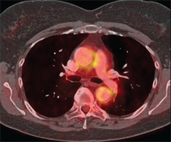 Giant Cell Arteritis Challenging to Diagnose, Manage :: Article - The Rheumatologist | Rheumatology-Rhumatologie | Scoop.it
